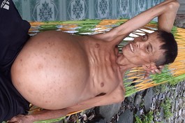 Mở rộng lòng từ: Giúp người đàn ông bị ung thư gan