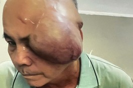 Mở rộng lòng từ: Ung thư tái phát không tiền điều trị