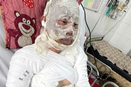 Mở rộng lòng từ: Bị bỏng nặng không tiền điều trị