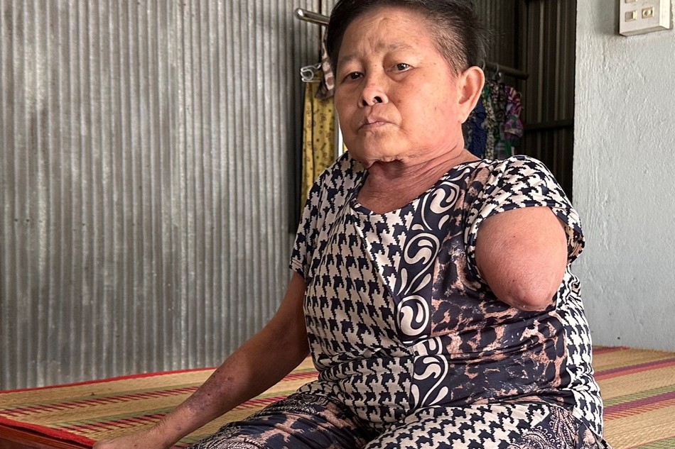 Mở rộng lòng từ: Bệnh tắc nghẽn mạch máu phải đoạn tay 