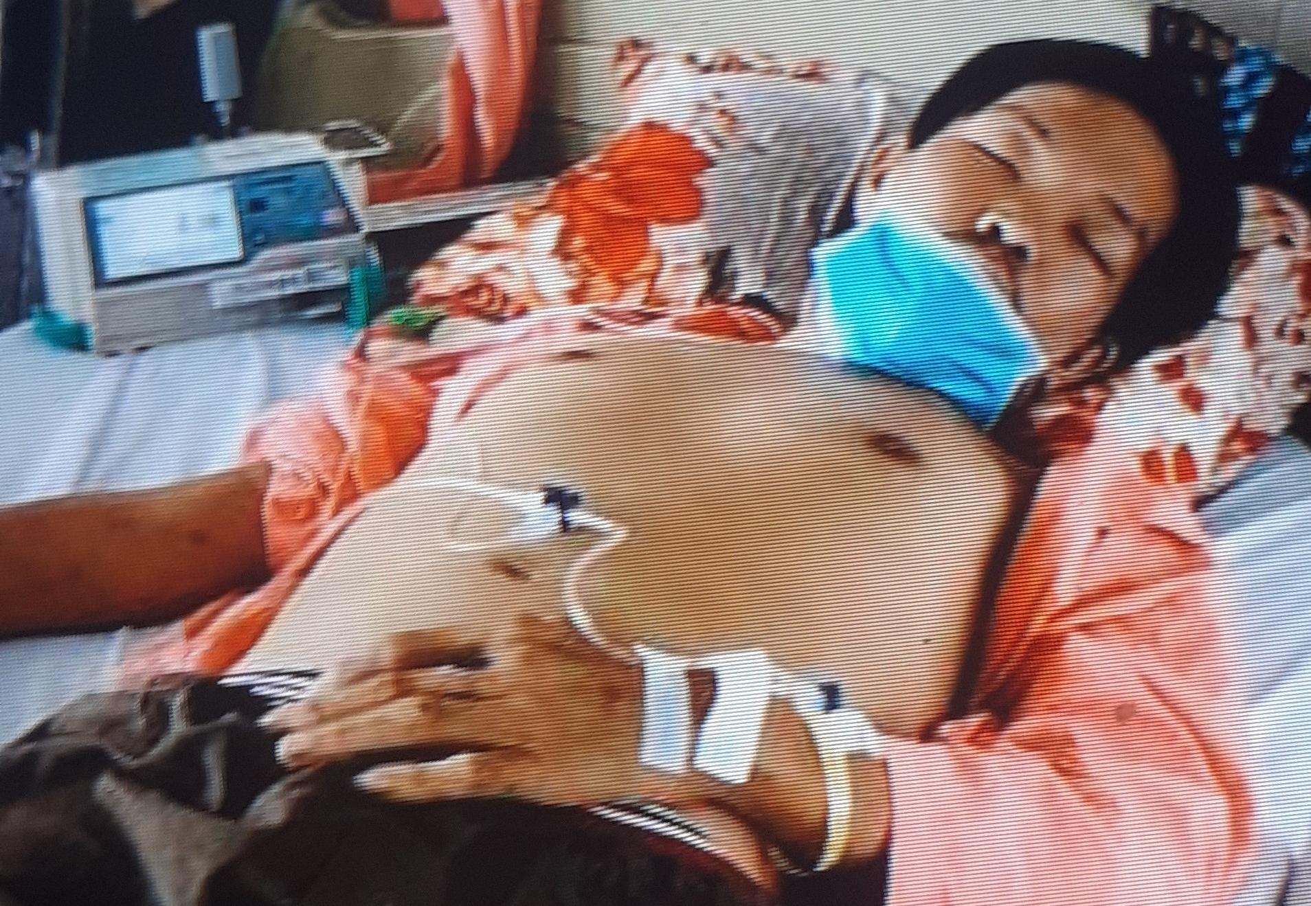 Anh Phạm Minh Hải, 36 tuổi áp-xe thận trái, viêm phổi, viêm gan