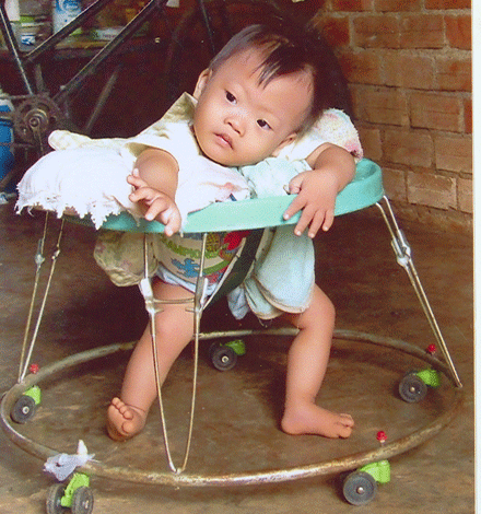 Bé bị bệnh tim bẩm sinh