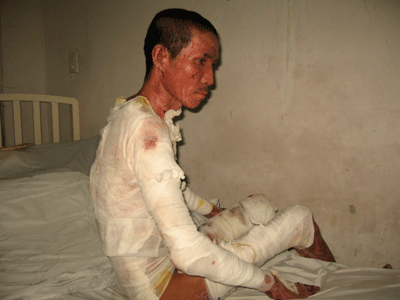 Cả gia đình bị bỏng nặng