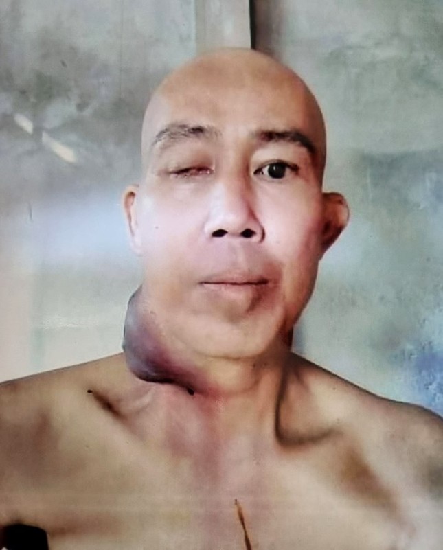 Ông Nguyễn Hồng Nhứt, sinh năm 1977 bị ung thư vòm hầu Ông Nguyễn Hồng Nhứt, sinh năm 1977 bị ung thư vòm hầu