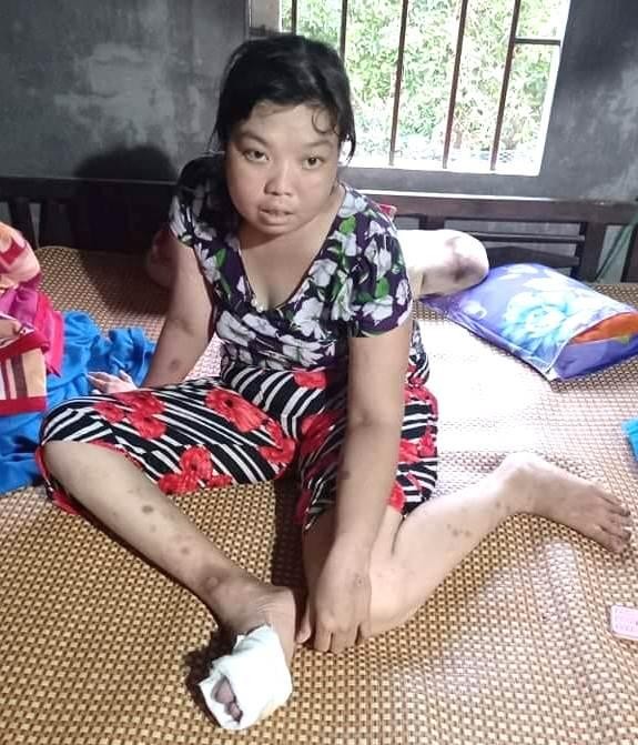 Thúy Hiền bị đái tháo đường, thuyên tắc, huyết khối động mạch chủ bụng, biến chứng loét các ngón chân