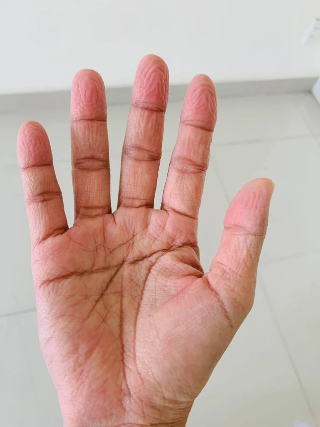 Bàn tay nhăn nhúm vì đeo bao tay cao su nhiều giờ liền