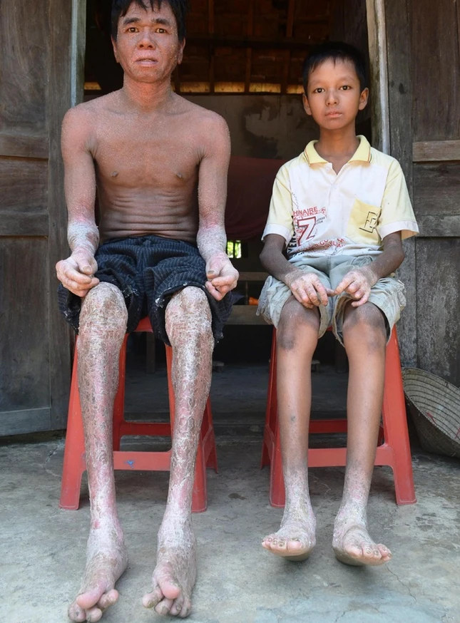 Căn bệnh lạ khiến chân tay của 2 cha con ở Quảng Nam co quắp, toàn thân xuất hiện nhiều vảy sừng cứng và liên tục lột da như rắn rất đau đớn