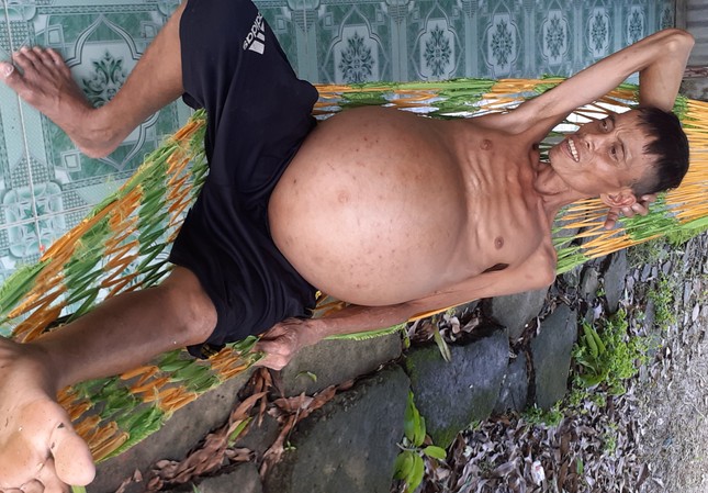 Ông Trần Văn Ngoan bị ung thư gan