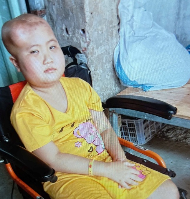 Cháu Lê Ngọc Bảo Trâm, sinh năm 2015 bệnh u não Cháu Lê Ngọc Bảo Trâm, sinh năm 2015 bệnh u não