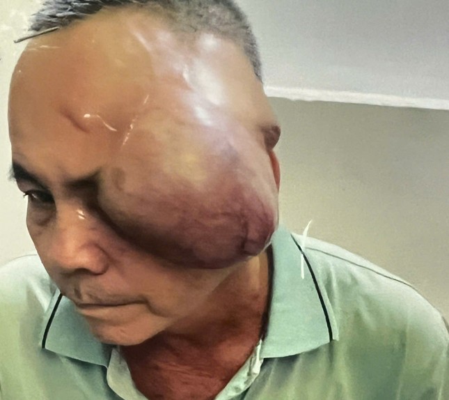 Anh Trăng đã bị bướu trùm xuống mắt