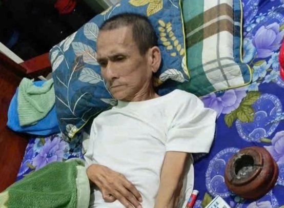 Ông Nguyễn Đình Minh bị bệnh xuất huyết não