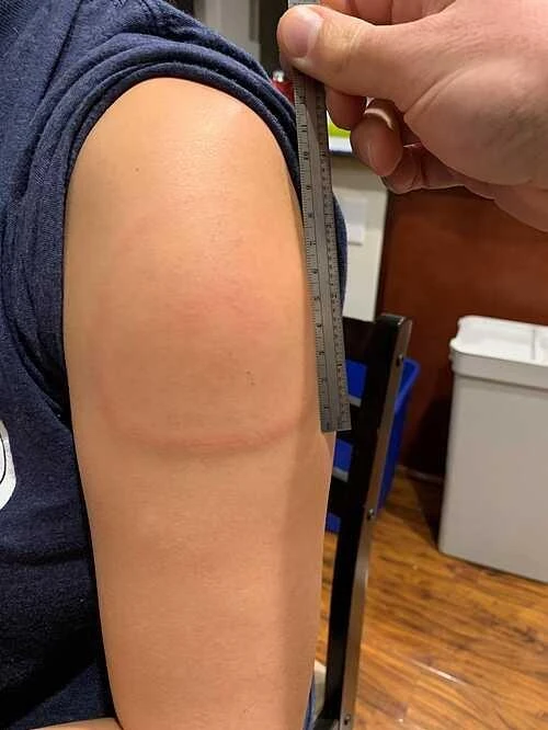 Vết phát ban cánh tay dài 15cm ở người tiêm vắc-xin Moderna - Ảnh: Mass General Brigham Hospital