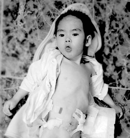 Giúp bé Hoàng Anh phẫu thuật tạo hình hậu môn ảnh 1 Be Hoang Anh.jpg