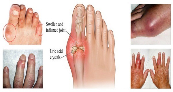 benh-gout56.jpg