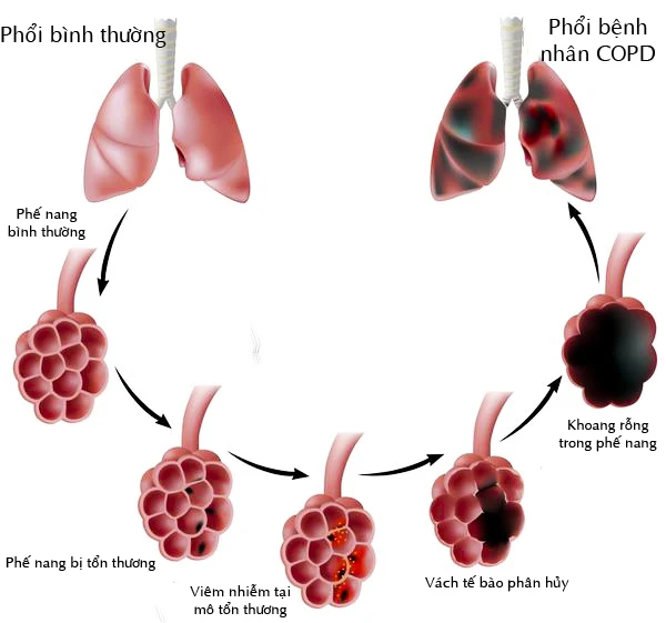 benh-copd.jpg