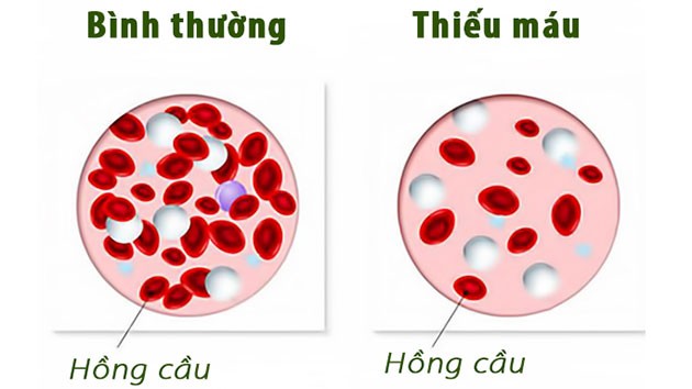 benh-thieu-mau.jpg