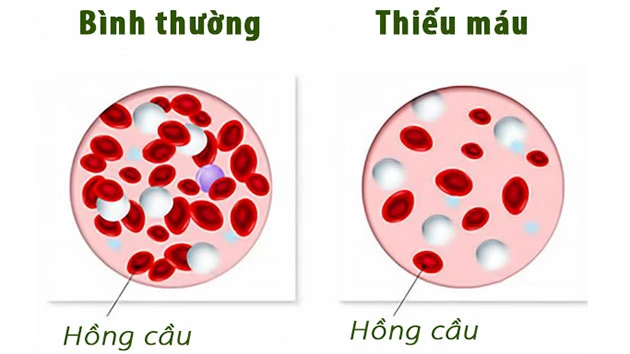 benh-thieu-mau.jpg