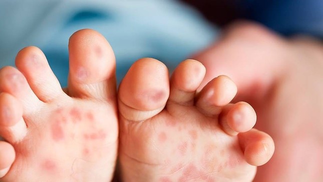 Bệnh tay chân miệng ở TP.HCM tăng nhanh ảnh 1 taychanmieng.jpg