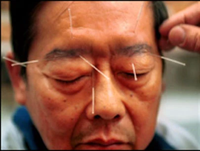 Tại sao nên trị đau đầu bằng châm cứu?
