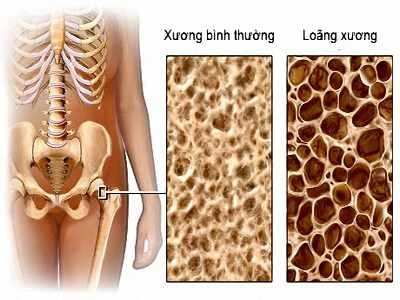 Bệnh loãng xương không chỉ gặp ở nữ giới