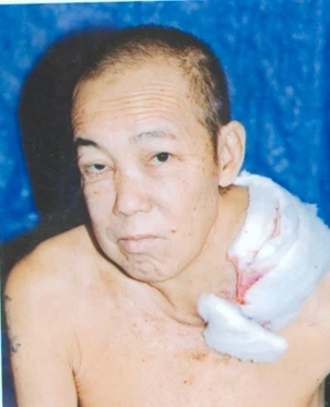 Giúp ông Toàn điều trị ung thư bướu cổ