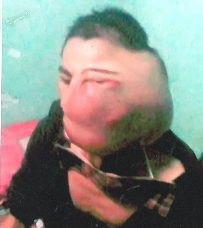 Anh Nguyễn Tuấn Khanh bị khối u lớn