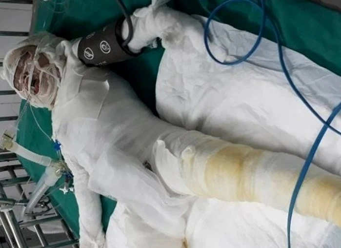 Cháu bé rơi vào lò vôi cần giúp đỡ