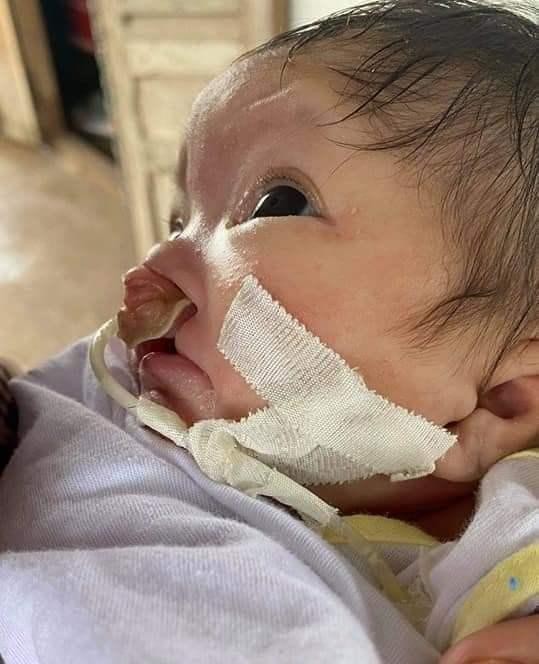 Bé Trường Duy đã hơn 2 tháng tuổi nhưng do bị hở hàm ếch