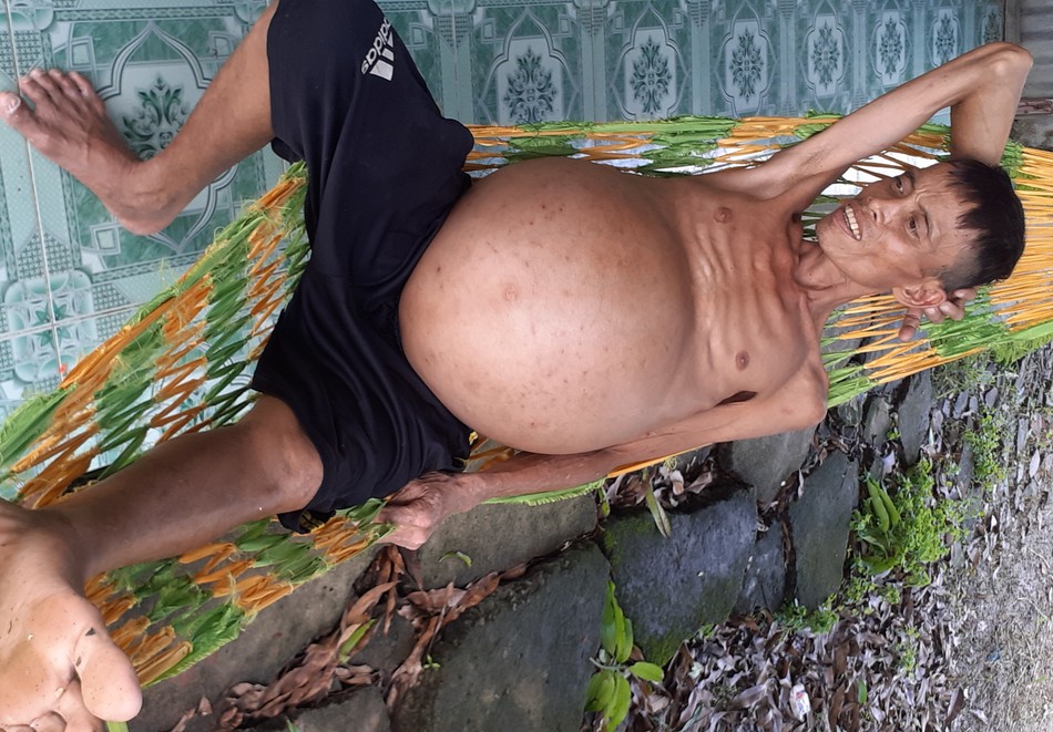 Ông Trần Văn Ngoan bị ung thư gan Ông Trần Văn Ngoan bị ung thư gan