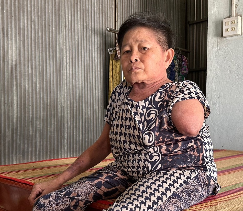 Bà Hiệp phải phẫu thuật cắt bỏ tay trái do bị tắc ngẽn mạch máu Bà Hiệp phải phẫu thuật cắt bỏ tay trái do bị tắc ngẽn mạch máu